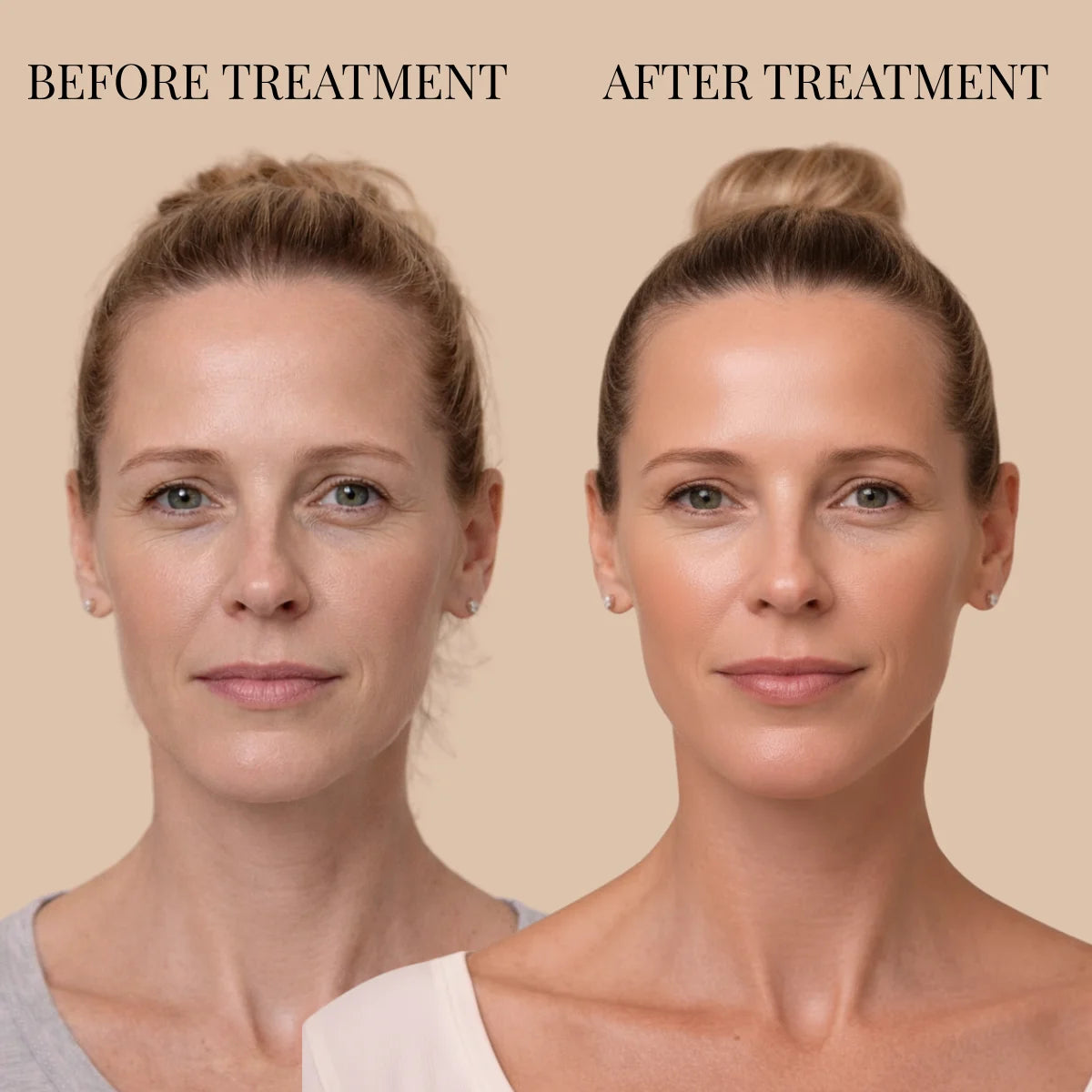 DERMASKIN | SculptLift